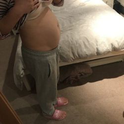 Tôi có phù hợp với hút mỡ siêu âm Vaser không? Tôi lo mình phải phẫu thuật tạo hình bụng