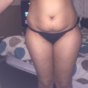 Nên hút mỡ bằng sóng siêu âm VASER hay hút mỡ truyền thống