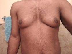 Hút mỡ bằng sóng siêu âm Vaser có phải là giải pháp tốt nhất để loại bỏ mỡ thừa trên ngực nam giới không?