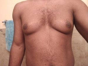 Hút mỡ bằng sóng siêu âm Vaser có phải là giải pháp tốt nhất để loại bỏ mỡ thừa trên ngực nam giới không?