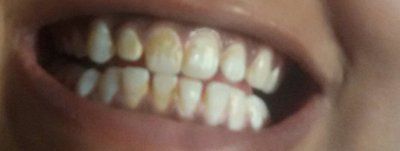 Cách loại bỏ những vùng nâu vàng trên răng?