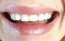 Cần phải mài đi bao nhiêu răng trước khi gắn mặt dán sứ Veneer hoặc mặt dán sứ Lumineer?