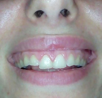 Men răng mỏng khắc phục bằng cách nào?