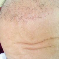 Điều gì xảy ra sau một tháng sau cấy tóc bằng kỹ thuật FUE?