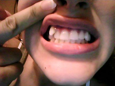 Có cần phải nhổ răng để đeo niềng răng trong suốt không?