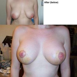 Hai bên núm vú không đều nhau sau nâng ngực chảy xệ và đặt túi độn