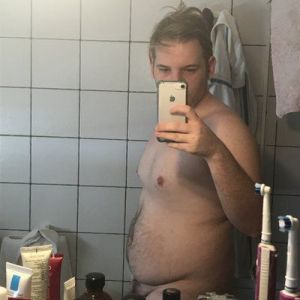 Hút mỡ bằng sóng siêu âm VASER hay phẫu thuật tạo hình bụng tốt cho tôi