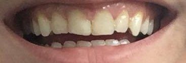 Răng mọc chen chúc nên chọn cách dán sứ hay niềng răng trong suốt?