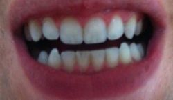 Răng nhọn và mẻ: nên chọn dán bonding hay dán sứ Veneer?