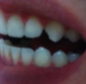 Răng nhọn và mẻ: nên chọn dán bonding hay dán sứ Veneer?