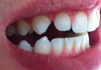 Răng nhọn và mẻ: nên chọn dán bonding hay dán sứ Veneer?