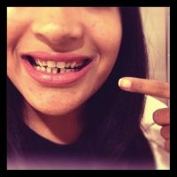 Răng thưa hàm dưới và dán composite