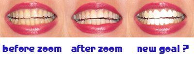 Răng bị xỉn màu do dùng thuốc kháng sinh tetracycline: nên chọn mặt dán sứ Veneer hay mặt dán sứ Lumineer?