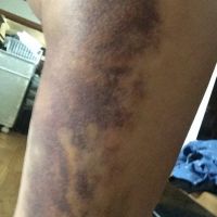 Sưng, bầm tím và bắp đùi lạnh có phải là điều bình thường sau khi hút mỡ bằng siêu âm Vaser hay không?