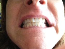 Cách tẩy trắng răng hiệu quả nhất cho răng bị đục và xám?