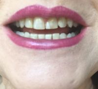 Nên chọn dán Bonding hay dán sứ Veneer để thay thế cho mặt dán composite cũ bị mẻ và ngả màu?