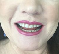 Nên chọn dán Bonding hay dán sứ Veneer để thay thế cho mặt dán composite cũ bị mẻ và ngả màu?