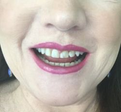 Nên chọn dán Bonding hay dán sứ Veneer để thay thế cho mặt dán composite cũ bị mẻ và ngả màu?