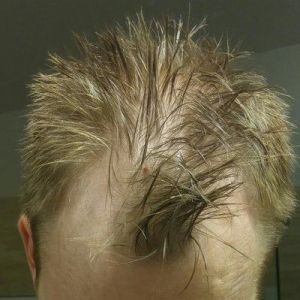 Tôi có phù hợp với cấy tóc không, nếu có thì nên thực hiện kỹ thuật FUT hay FUE? 34 tuổi, có nên đợi không?