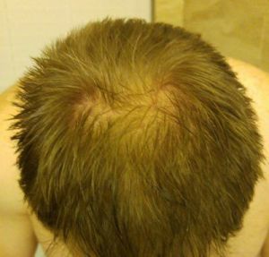 Tôi có phù hợp với cấy tóc không, nếu có thì nên thực hiện kỹ thuật FUT hay FUE? 34 tuổi, có nên đợi không?