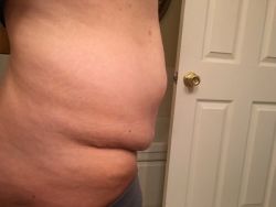 Hút mỡ siêu âm VASER có phải là lựa chọn phù hợp với tôi?