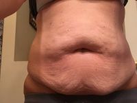 Hút mỡ siêu âm VASER có phải là lựa chọn phù hợp với tôi?