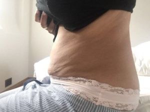 3 tháng sau hút mỡ Vaser tại sao bụng bị biến dạng, hai bên đùi thì trông rất khủng khiếp, tôi trông còn béo hơn