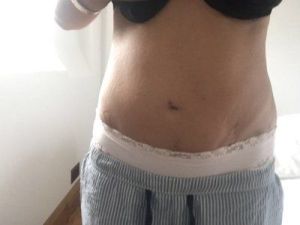 3 tháng sau hút mỡ Vaser tại sao bụng bị biến dạng, hai bên đùi thì trông rất khủng khiếp, tôi trông còn béo hơn