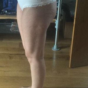 3 tháng sau hút mỡ Vaser tại sao bụng bị biến dạng, hai bên đùi thì trông rất khủng khiếp, tôi trông còn béo hơn