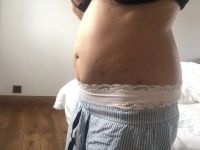 3 tháng sau hút mỡ Vaser tại sao bụng bị biến dạng, hai bên đùi thì trông rất khủng khiếp, tôi trông còn béo hơn