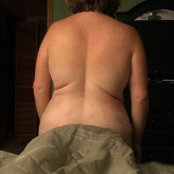 48 giờ sau khi hút mỡ Vaser ở vùng áo ngực, lưng và đùi dưới