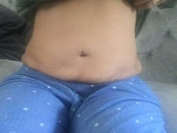 Bụng to hơn sau khi hút mỡ bằng sóng siêu âm VASER được 8 tuần- điều này có bình thường không?