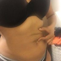 Da bị chùng nhão và có nếp nhăn sau khi hút mỡ VASER. Làm sao để cải thiện?