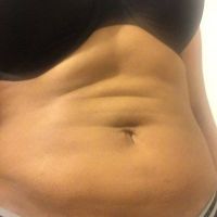 Da bị chùng nhão và có nếp nhăn sau khi hút mỡ VASER. Làm sao để cải thiện?