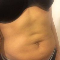 Da bị chùng nhão và có nếp nhăn sau khi hút mỡ VASER. Làm sao để cải thiện?