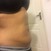 Da bị chùng nhão và có nếp nhăn sau khi hút mỡ VASER. Làm sao để cải thiện?