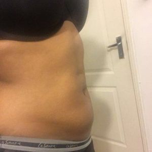 Da bị chùng nhão và có nếp nhăn sau khi hút mỡ VASER. Làm sao để cải thiện?