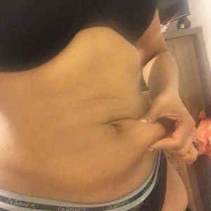 Da bị chùng nhão và có nếp nhăn sau khi hút mỡ VASER. Làm sao để cải thiện?