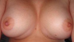 Liệu hiện tượng gò ngực kép có tự hết không?