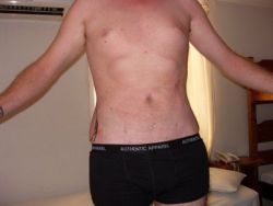 Lo lắng về hai bên hông sau hút mỡ bằng sóng siêu âm Vaser