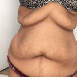 Hút mỡ và loại bỏ da thừa