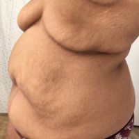 Hút mỡ và loại bỏ da thừa Hút mỡ và loại bỏ da thừa