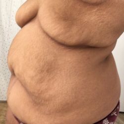 Hút mỡ và loại bỏ da thừa