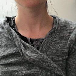 Hút mỡ VASER ở cằm – quá trình hồi phục và kết quả