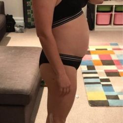 Tôi đã hút mỡ VASER cách đây 4 ngày, nhưng bụng tôi vẫn phình ra rất nhiều