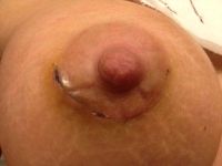 Tôi đã mổ được 17 ngày nhưng hai bên quầng vú lành lại khác nhau, điều này có bình thường không?