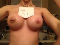 Tôi đã mổ được 17 ngày nhưng hai bên quầng vú lành lại khác nhau, điều này có bình thường không?