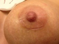 Tôi đã mổ được 17 ngày nhưng hai bên quầng vú lành lại khác nhau, điều này có bình thường không?