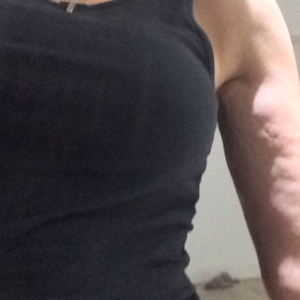 Tôi đã hút mỡ VASER ở hai bên cánh tay được 5 tháng, tôi muốn bắp tay săn chắc hơn nhưng kết quả thật sự tệ
