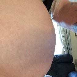 Tôi đã sinh 4 con và không có khả năng ra nước ngoài để phẫu thuật tạo hình bụng. Liệu hút mỡ VASER có giúp ích không?